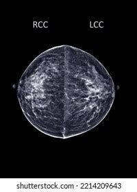 Xray Digital Mammogram Mammography Both Side Stock Illustration ...