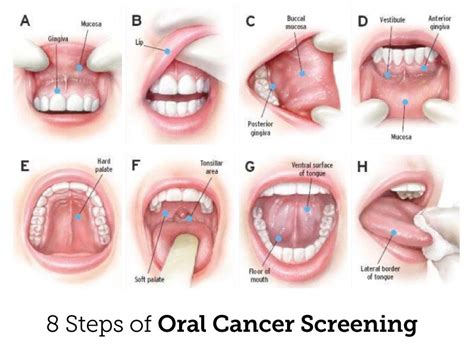 How To Do An Oral Cancer Screening - CancerWalls