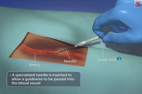 Cardiac Catheterization app uses visual animations for patient education about heart procedures