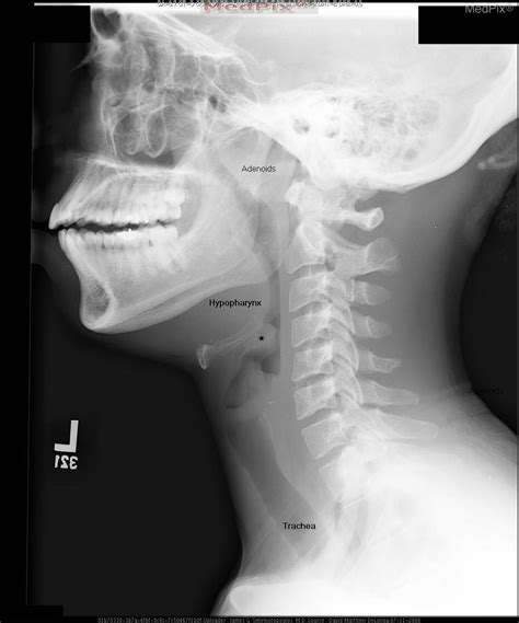 Normal Epiglottis X Ray