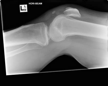 Patellar tendon avulsion fracture | Radiology Case | Radiopaedia.org