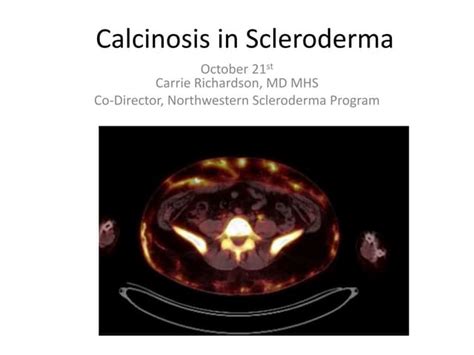 Scleroderma & the hands - Calcinosis | PPT