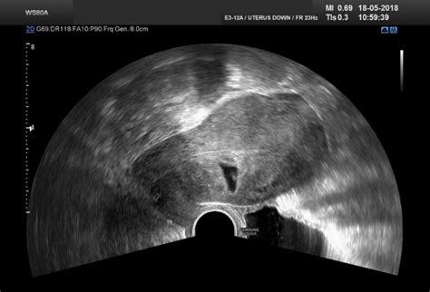 Pregnancy in a Cesarean Section – ISGE