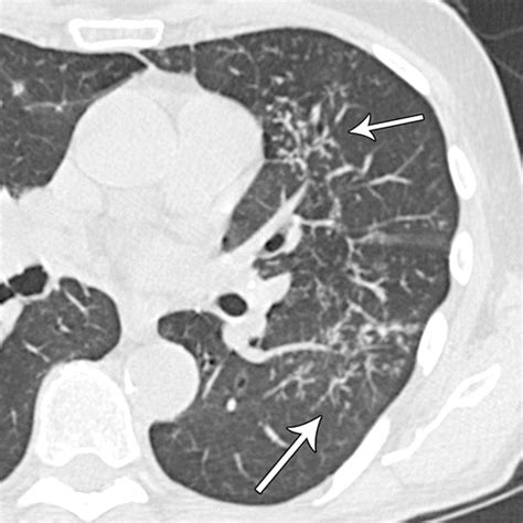 Bronchiolitis: A Practical Approach for the General Radiologist | RadioGraphics