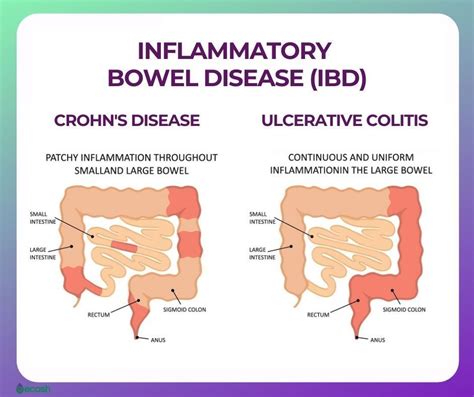 Tim Crowe on LinkedIn: Inflammatory bowel disease (IBD) is an umbrella ...