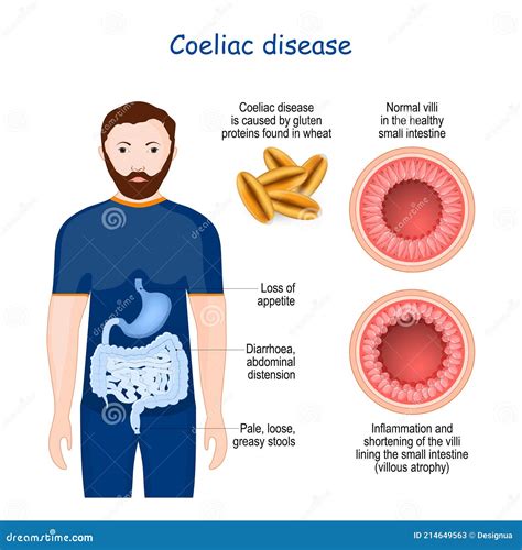 Coeliac Disease. Celiac Autoimmune Disorder Stock Vector - Illustration of inflammation, human ...