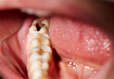 What are the Signs of Tooth Decay?