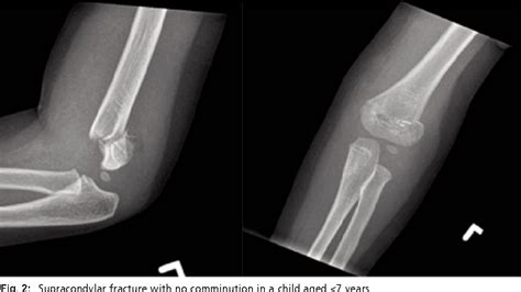 Figure 2 from Displaced Supracondylar Humerus Fractures in Children ...