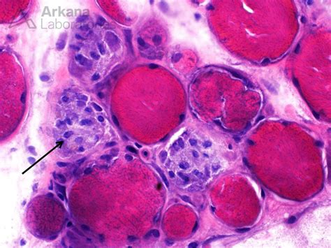 Rhabdomyolysis | Teaching Point | Arkana Laboratories