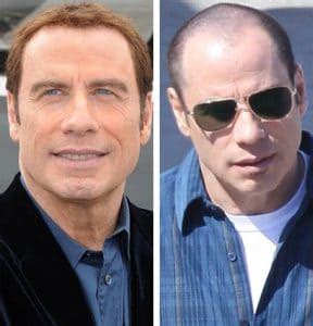 John Travolta Hair Transplant | Hair Transplant Dubai