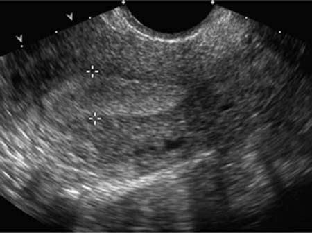 Postmenopausal Vaginal Bleeding | Radiology Key