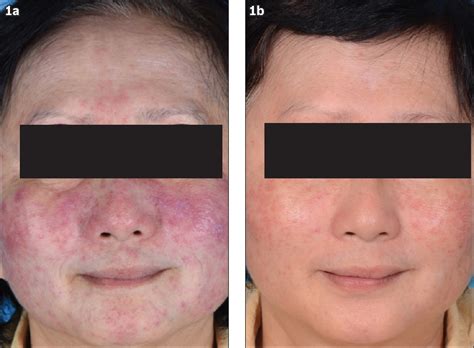 A case report of granulomatous rosacea of the face | SMJ