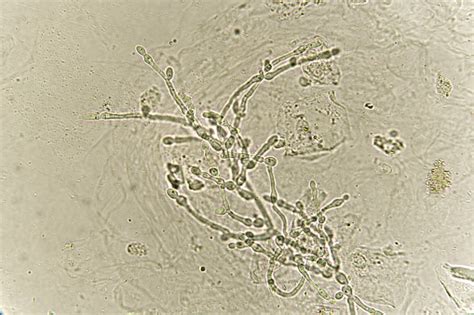 Pseudohyphae And Budding Yeast Cells In Urine Stock Photo - Download Image Now - Thrush - Yeast ...