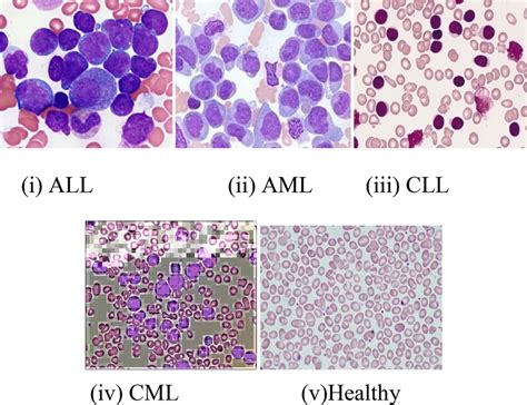 Acute Lymphoblastic Leukemia Diagram