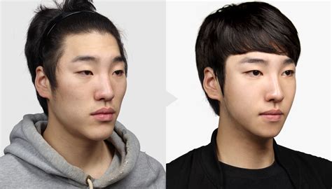 TL PLASTIC SURGERY CLINIC KOREA: Male Plastic Surgery Before&After★