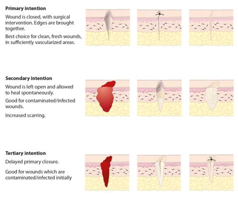 Principle of wound management - RCEMLearning India