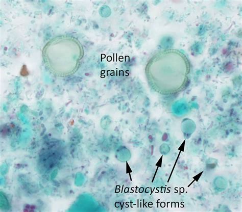 Blastocystis & blastocystis hominis, causes, symptoms, diagnosis ...