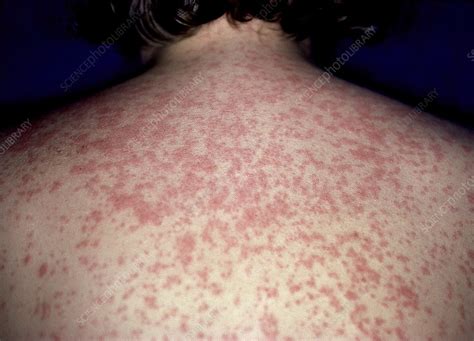 Measles rash - Stock Image - C052/9801 - Science Photo Library