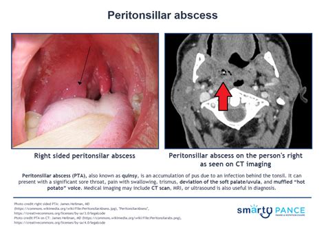 Peritonsillar abscess (smartypance.com) Diagram | Quizlet