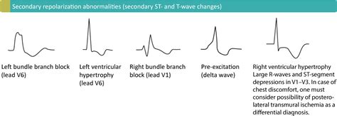 The T-wave: physiology, variants and ECG features