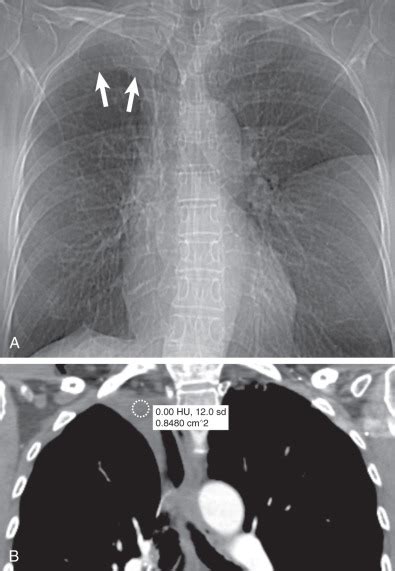 Benign Asbestos Pleural Effusion Uptodate : Diseases of the pleura