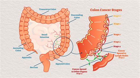 Hen period reference colon cancer lymph nodes Debtor cold Treason