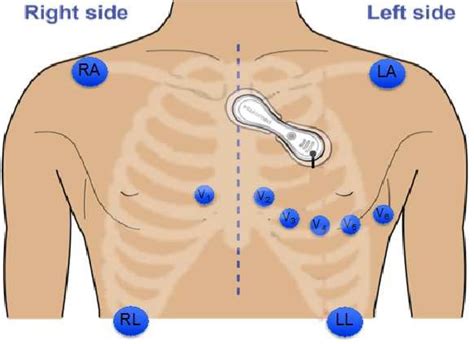 Electrode placement layout of Holter Monitor (blue electrodes are for... | Download Scientific ...