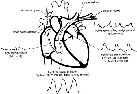 The Pulmonary Artery Catheter - Cardiology Clinics