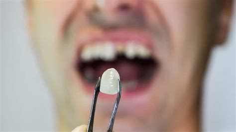 Cracked Tooth After Root Canal: Can It Be Saved?