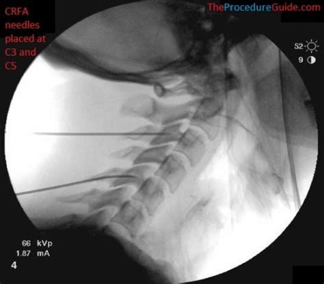 Fluoroscopic Guided Hip Joint Injection - Technique and Overview - The ...