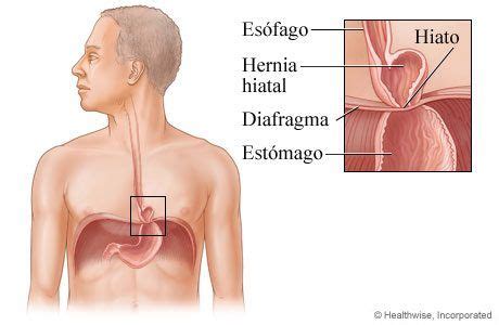 Hernia de hiato: descripción, consejos y dieta saludable.