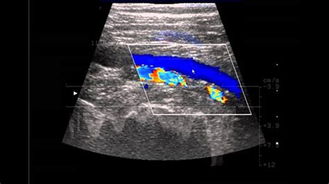 Venous Ultrasound Exam: Ultrasound Assisted Vein Examination - SIFSOF