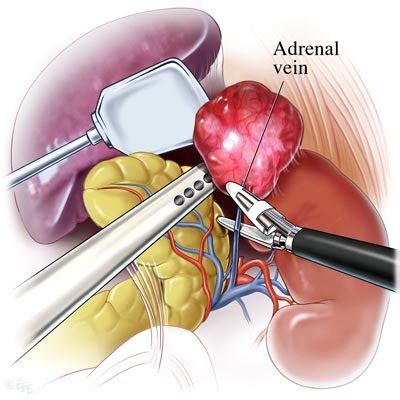 Diseases of the Adrenal Gland — Suncoast Surgical Associates