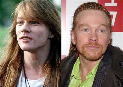 Did Axl Rose Have Plastic Surgery?