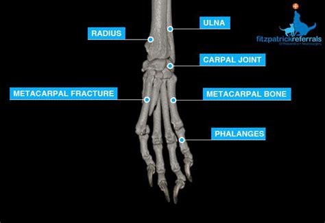 Metacarpal Fracture - Fitzpatrick Referrals