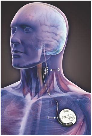 Vagal nerve stimulators? - Questions and Answers in MRI