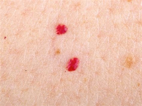 What Are Red Moles, And Are They Dangerous?