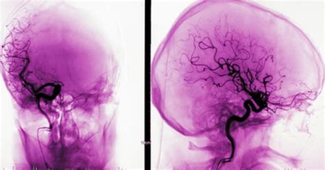 Cerebral Angiography (Brain Angiogram): Why It's Done, Risks, What to Expect