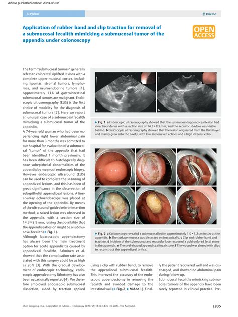 (PDF) Application of rubber band and clip traction for removal of a submucosal fecalith ...