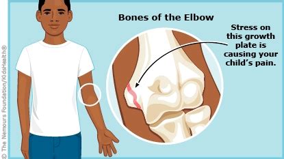 Little League Elbow (for Parents) - Nemours KidsHealth