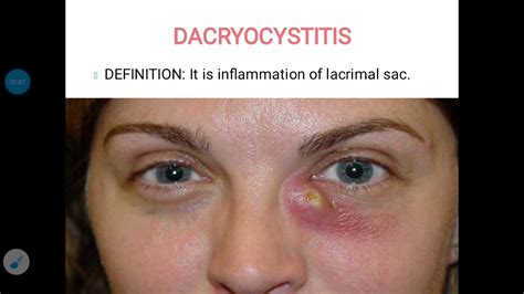 Dacryocystitis - YouTube