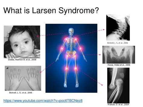 PPT - Larsen Syndrome PowerPoint Presentation - ID:2383102