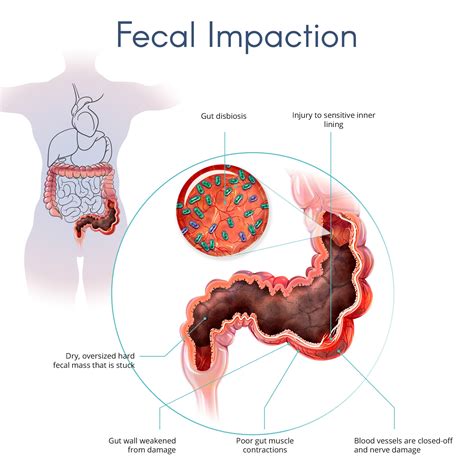 Fecal Impaction Cleanse. Natural Therapy Works Better Than - Etsy