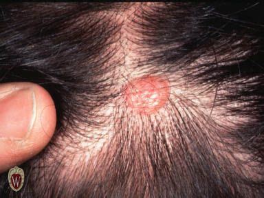 Primary skin lesion. Nodule This nodule is a basal cell carcinoma on the scalp of a 23-year-old man.