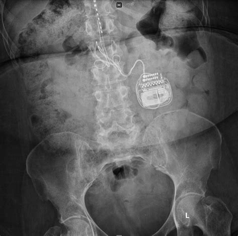 Spinal Stimulator - MR Conditional - MR IMPLANT