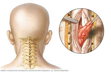 Spinal cord tumor - Diagnosis and treatment - Mayo Clinic