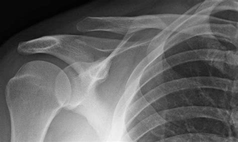 What is an AC joint separation or a shoulder separation?: Brent J ...