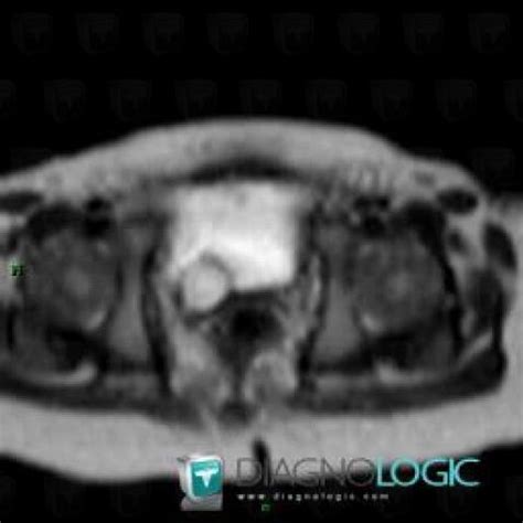 Radiology case : Ureterocele (US ,MRI) - Diagnologic