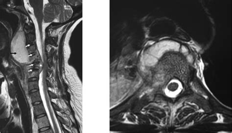 Spinal Tuberculosis - Spine - Orthobullets