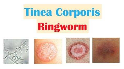 Ringworm Home Treatment: Discover The Secret To Remove Ringworm ...